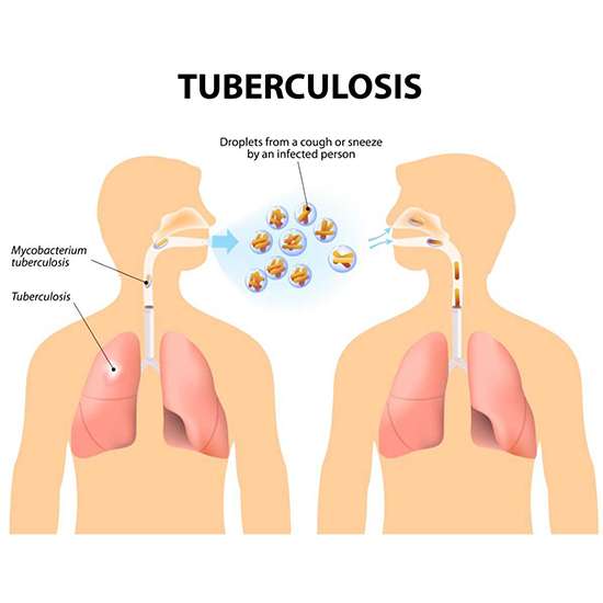 Tuberculosis - Signs and symptoms, Risk factors & Treatment